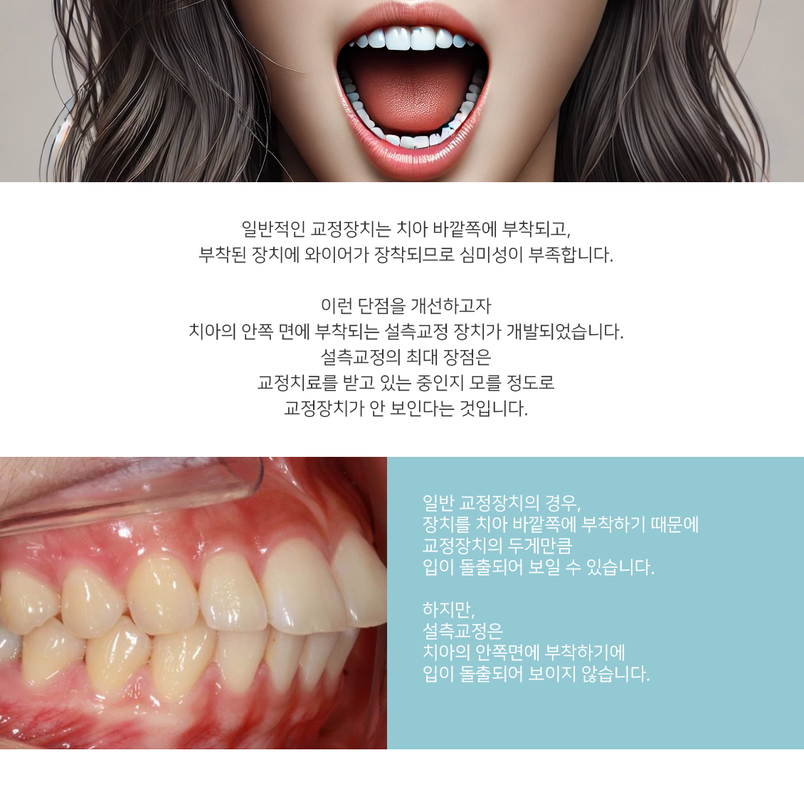 설측교정